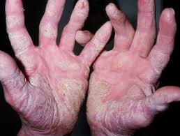There are several types of classification criteria for psoriatic arthritis (caspar) are helpful for diagnosing psoriatic arthritis; Psoriazis Palmar Imagini