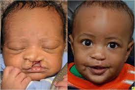 Cleft lip and cleft palate repair is surgery to close the openings in your child's lip or mouth. Cleft Lip And Cleft Palate Johns Hopkins Facial Plastic And Reconstructive Surgery
