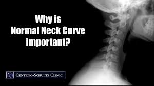 However, after certain structural stressors, many people—including children and the elderly—have a reversal of this findings: Straightening Of The Cervical Lordosis Losing Your Normal Neck Curve