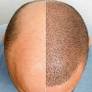 hair transplant in islamabad from drafsheenbilal.com