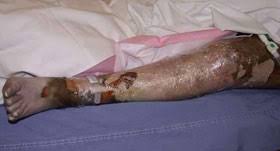 Often eschar (dry, black necrotic tissue) will form around the wound. Circumferential Burns Vic Burns