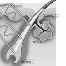 Other potential side effects are swelling, redness, and scarring. Pdf Biological And Clinical Aspects In Laser Hair Removal