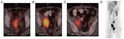 It's possible for your cervical cancer to come back in a lot of cases, treatment works and the cancer never comes back. Pet Ct Imaging Analysis Of Recurrent Sites And Patterns Of Spread Following Modified Radical Surgery Type B For Stage Ib Iia Cervical Cancer