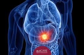 This turns the skin and the eyes yellow, a condition called. Pancreatic Cancer Symptoms Everyone Should Watch Out For