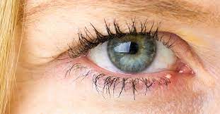Das hagelkorn befindet sich oben am auge auf dem augenlid. Hagelkorn Am Auge Diagnose Und Behandlung Iclinic At