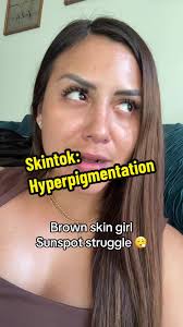 Hyperpigmentation Girl Front View