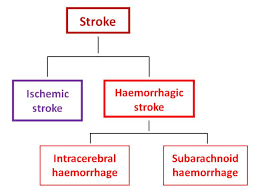 Image result for Stroke Pathophysiology