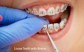 Sometimes it may get loose or fall out of braces if you don't clean teeth following the ideal method of brushing and flossing with forsus springs and braces. Loose Teeth With Braces Invisalign Support
