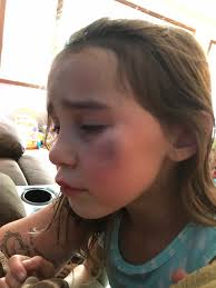 Dangers of bouncy beds for children's spine health