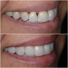This is the safest teeth whitening procedure available. Teeth Whitening Glendale Burbank Teeth Whitening Pacific Dental Care