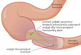 Image result for Intussusception