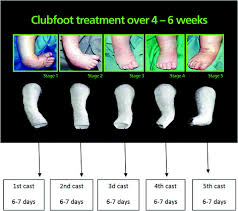 Clubfoot, also known as congenital talipes equinovarus, is a complex, congenital deformity of the foot, that left untreated can limit a person's mobility by making it difficult and painful to walk. Design And Development Of Orthosis For Clubfoot Deformity Springerlink