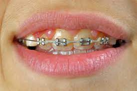 We did not find results for: How To Whiten Teeth With Braces Howstuffworks