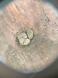 Image result for genital warts