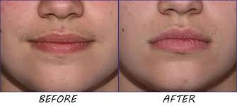 Similar to the merman craze, more men have been choosing blonde or platinum blonde as a hair color to change up their style and look. 13 Best Upper Lip Hair Ideas Upper Lip Hair Upper Lip Skin Bleaching