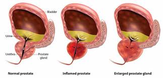 Enlarged Prostate Gland (BPH) | Froedtert & MCW