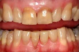 Image result for Tooth Discoloration