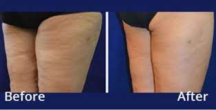 Morpheus8 Radio Frequency Improve Skin Texture Improve Skin