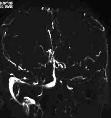 Kopfschmerzen, übelkeit, erbrechen aber auch bewußtseinstrübung, epileptische anfälle und zentrale paresen. Mri Library Sinusvenenthrombose