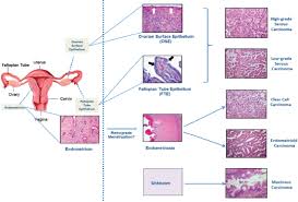 2 The Biology Of Ovarian Cancers Ovarian Cancers Evolving Paradigms In Research And Care The National Academies Press