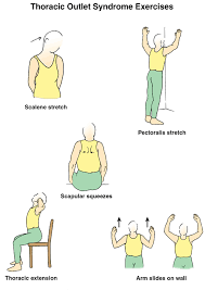 Exercises For Thoracic Outlet Syndrome Neck Arm Exercise Poster