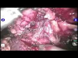 Newest Surgical Option For Kidney Cancer Youtube
