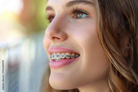 Teen girl with orthodontic braces, Michael Foto, Poster, Wandbilder bei  EuroPosters