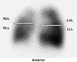 Image result for Ventilation Perfusion Scan