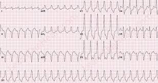 We are the home of ekg professionals, amateurs, and anyone else interested in interpreting ekgs. 66 Yo With Syncope Ventricular Tachycardia This Grepmed