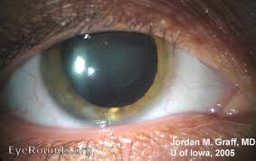 Marfan S Syndrome Eyerounds Org Online Ophthalmic Atlas