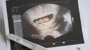 Weil ich mir selbst nicht getraut hab, hab ich nach gefragt und tatsächlich gibt es frauen bei denen das geht. Wann Ist Der Herzschlag Auf Dem Ultraschall Zu Sehen Focus De
