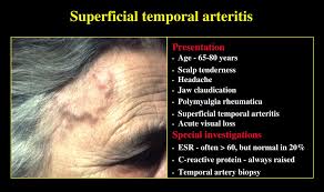 Image result for Jaw Claudication
