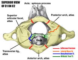 They are, however, hard at first to differentiate from each other. Atlas Fractures Transverse Ligament Injuries Spine Orthobullets