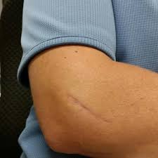 The Ache Is Gone How Elbow Surgery Can Help