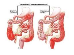 Όμως τα αέρια στην πραγματικότητα είναι μια. Flegmonwdeis Pa8hseis Toy Enteroy Symptwmata Diatrofh Antimetwpish Proionta Ths Fyshs