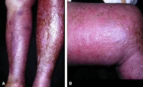 Image result for Lipodermatosclerosis