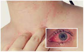 الأمراض الجلدية المعدية بالصور