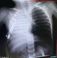 Check spelling or type a new query. Boy Who Is Half A Human With Just One Lung And Kidney And His Heart On The Wrong Side Daily Mail Online