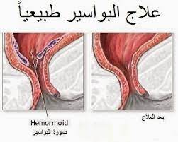 علاج البواسير طبيعيا بدون تدخل جراحي cure for hemorrhoids hemorrhoids home remedies for hemorrhoids
