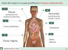 However, in rare cases it may also occur in other parts of the body. Endometriosi Cos E Sintomi Diagnosi Cura Ed Alimentazione