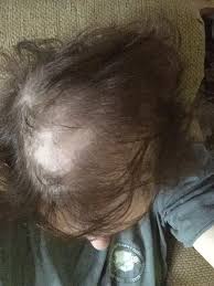 Explaining My Hair Loss To My Daughter Hair Loss Alopecia Hair Loss Women Hair Loss Bald