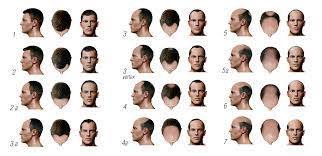 While women also struggle with thinning hair and hair loss, men. Classification Of Hair Loss In Men Maral Hair