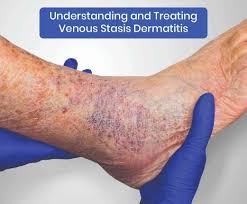 Image result for Stasis Dermatitis