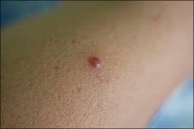 Cherry angiomas are cherry red papules on the skin containing an abnormal proliferation of blood ok, so first of all, that picture is not of me. Treatment Of Cherry Angioma In Ayurveda With Herbal Remedies Dr Vikram S Blog Ayurvedic And Herbal Remedies
