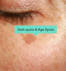 Image result for Melasma