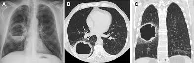 Image result for Lung Abscess