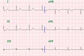 From wikipedia, the free encyclopedia. Clinical Significance Of Fragmented Qrs Complexes Or J Waves In Patients With Idiopathic Ventricular Arrhythmias