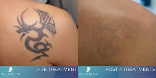 Illinois laser tattoo removal regulations. State Of The Art Laser Tattoo Removal