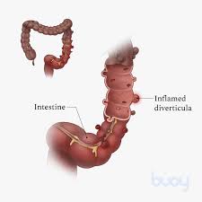 Symptoms of diverticular disease may include constipation, diarrhea, abdominal pain, or bloating. Diverticulitis 4 Symptoms Diagnosis