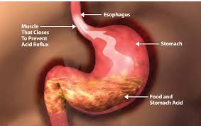 Your esophagus is the tube that carries food and liquids from your mouth to your stomach (see figure 1). Treatment Options For Gerd Or Acid Reflux Disease Comparative Effectiveness Review Summary Guides For Consumers Ncbi Bookshelf